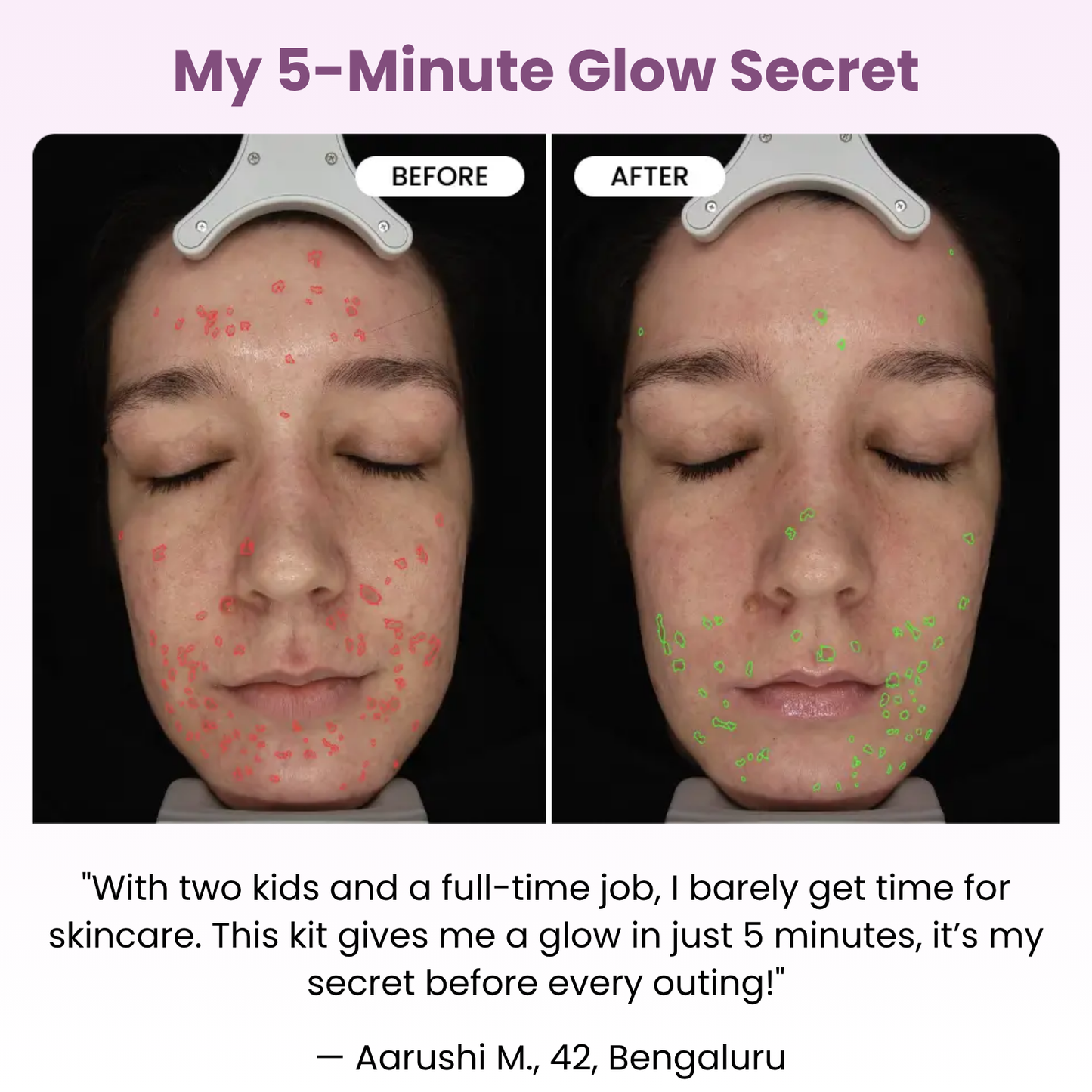 Micro Infusion Glow Kit