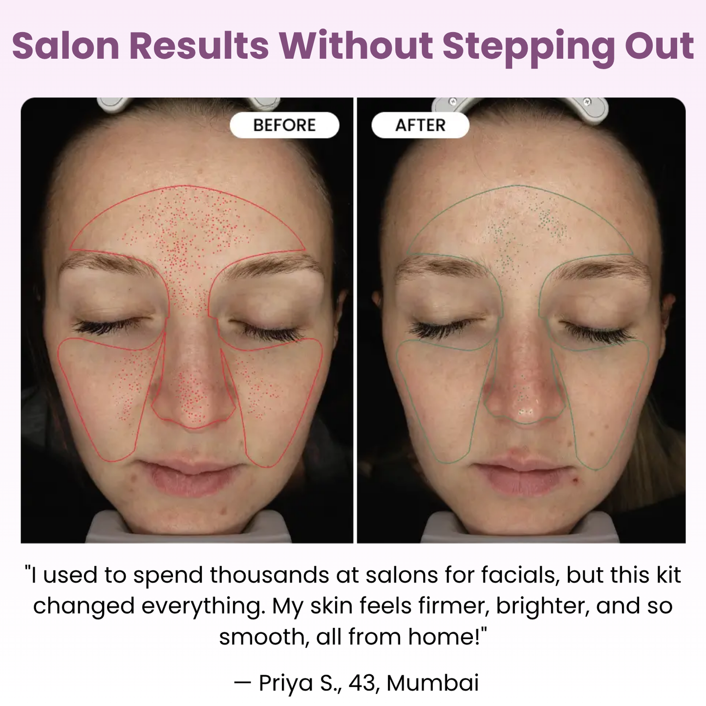 Micro Infusion Glow Kit